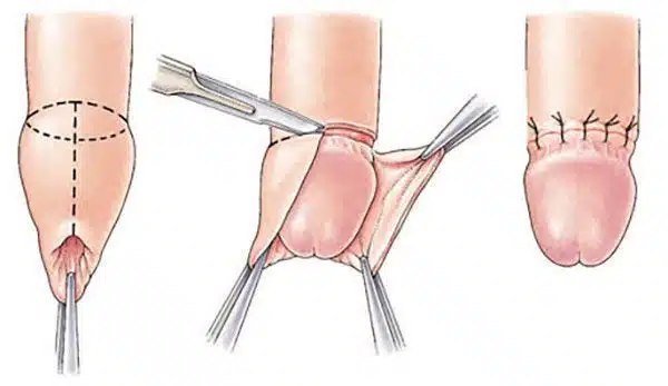 Obřízka penisu – ukázka z chirurgického zákroku