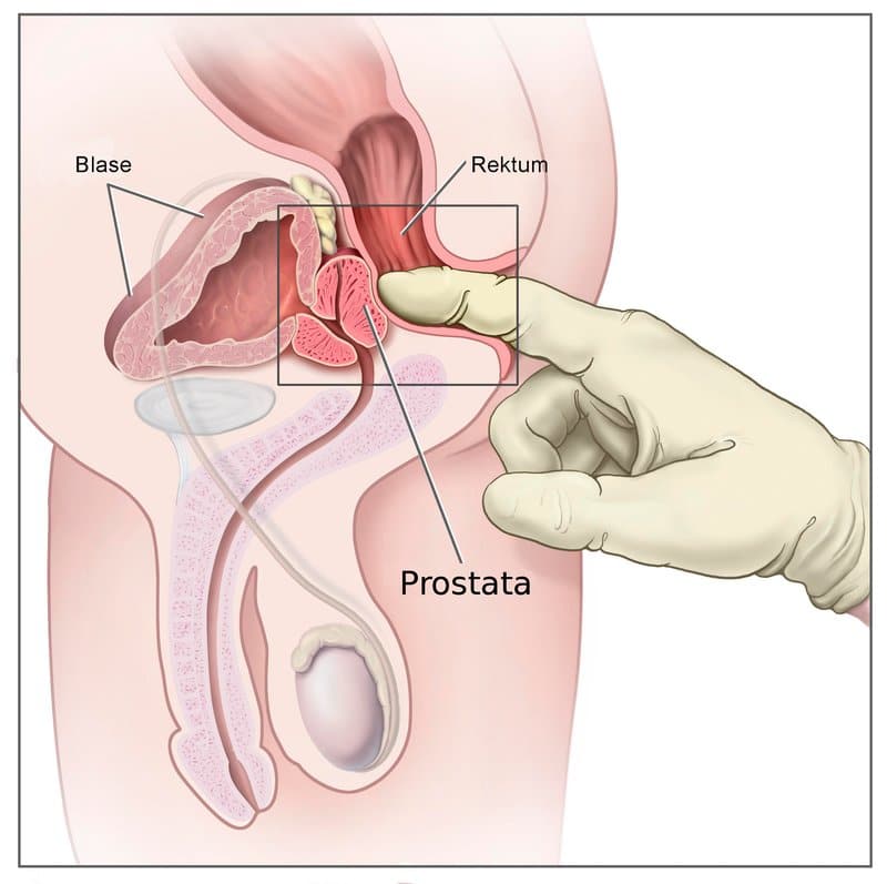 prostata a její příznaky